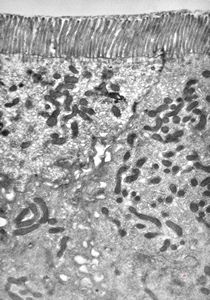 F,5y. | immotile cilia syndrome - trachea